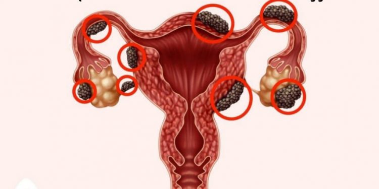 Opini : Penyakit Endometriosis